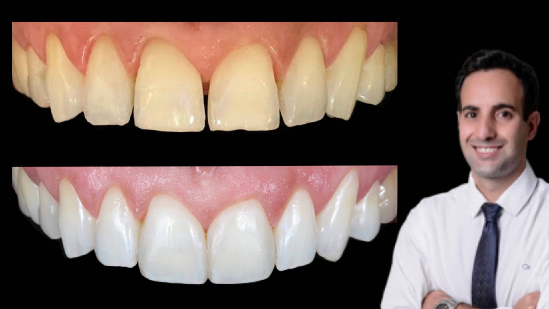 curso imersao lente de contato dental resina ilheus ba coa